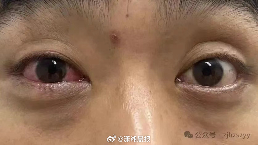 【#男子遇五步蛇想抓来玩被喷一脸毒#，医生提醒】据杭州市中医院，今年38岁的周大