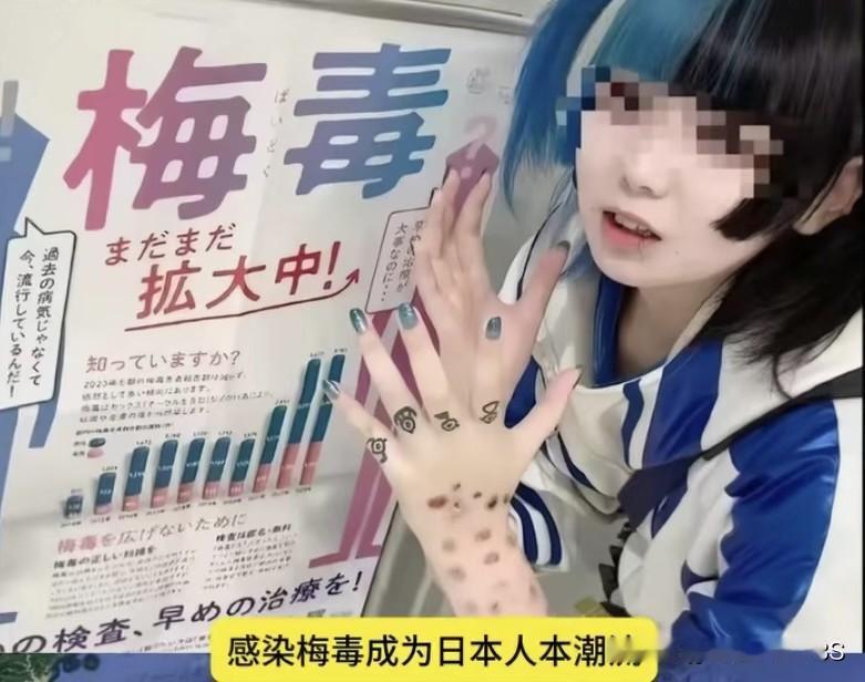 日本梅毒感染疯涨，年轻人居然把它当潮流晒，连续四年感染数都超1.3万例。
 
有