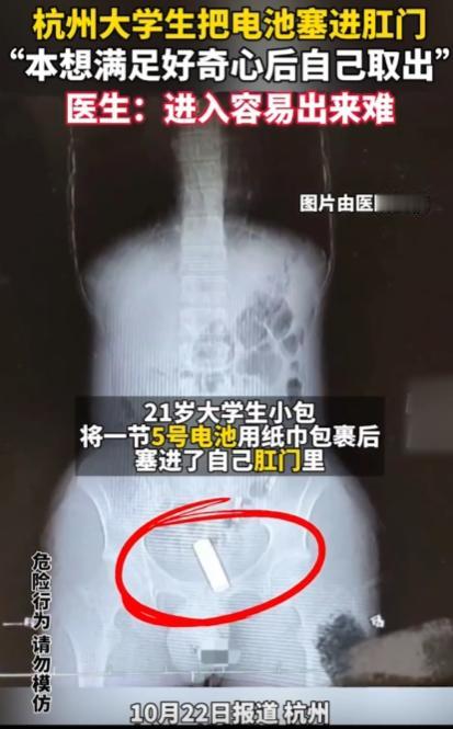 好奇心害死人！杭州，21岁大学生为寻刺激，将一节5号电池用纸巾包裹后，塞进了下体