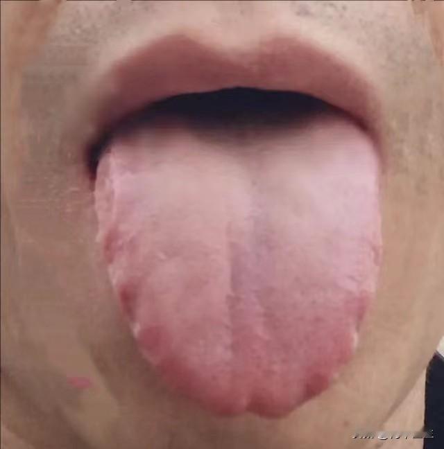 舌头成这样了，真心建议先把阳气补足，再讲湿气的事情，要不然真担心你调错方向，只会