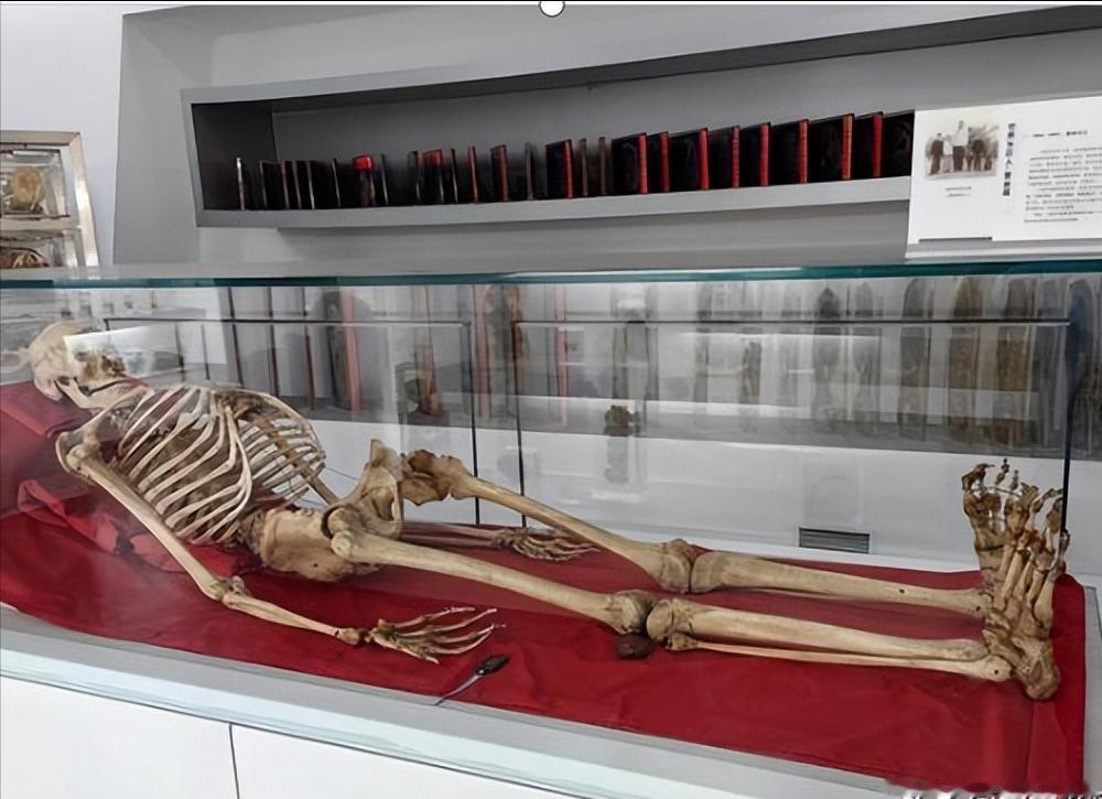 [微风]2005年，湖南湘雅医学院的标本室里，放着中国“第一女巨人”曾金莲的遗体