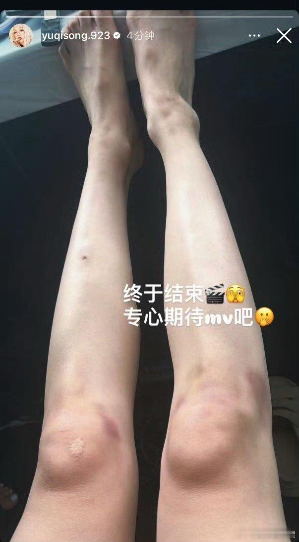 宋雨琦腿伤看完宋雨琦腿上大片淤青真的心疼，连续九天高强度拍摄MV，大量跪地舞蹈动