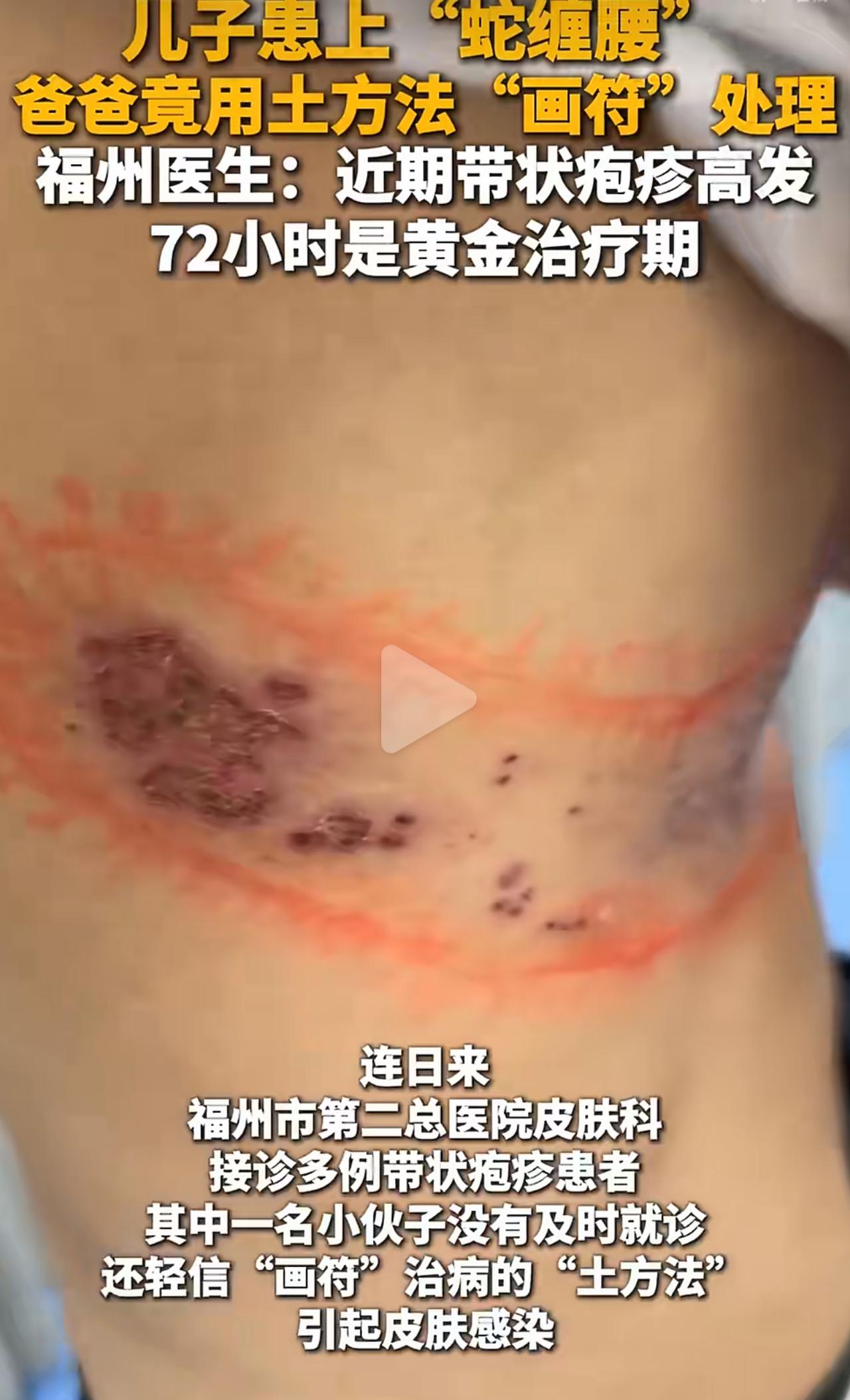 23岁小伙子得了蛇缠腰，疼得钻心。当爹的心急火燎，不信医院信偏方，非要找那橘红色