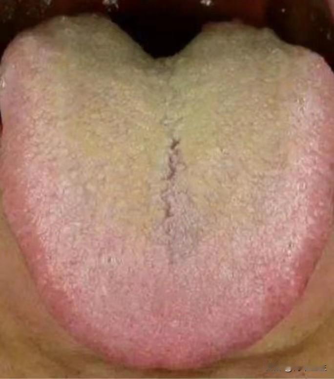 不要看见舌苔黄腻就祛湿热，你这个根本就不是那回事

今天遇见了一个很年轻的小伙子