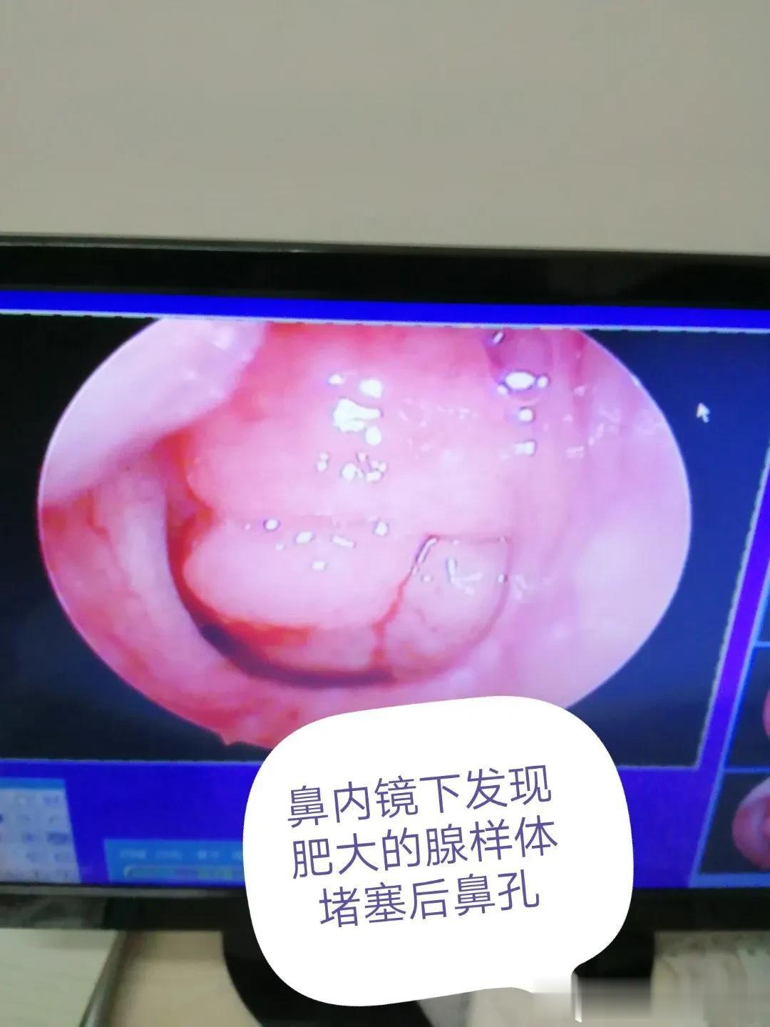 腺样体肥大三分治疗，七分预防

腺样体肥大的好发年纪大概是在三岁到七岁，十岁左右