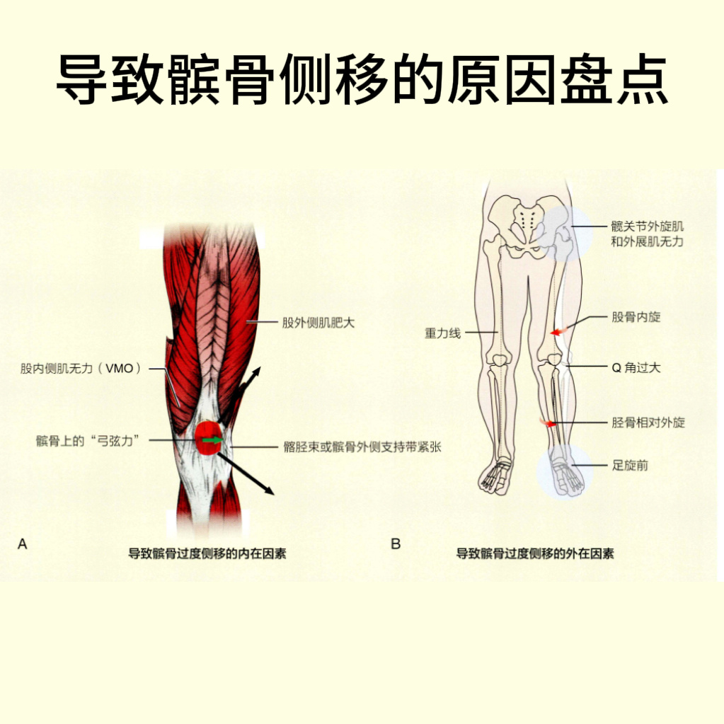 髌骨软化症  对于膝关节损伤，最常见的原因便是髌骨外移了——我们的髌骨，在股骨滑