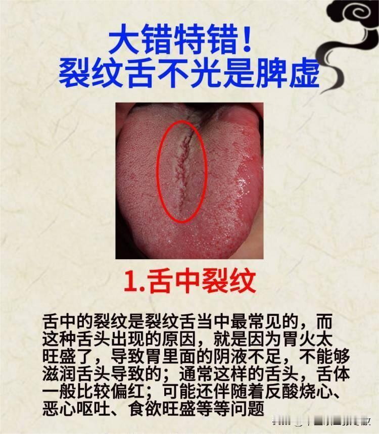 你知道吗？裂纹舌可不光是脾虚！[给力][给力]

图1：舌中裂纹——舌体偏红，胃