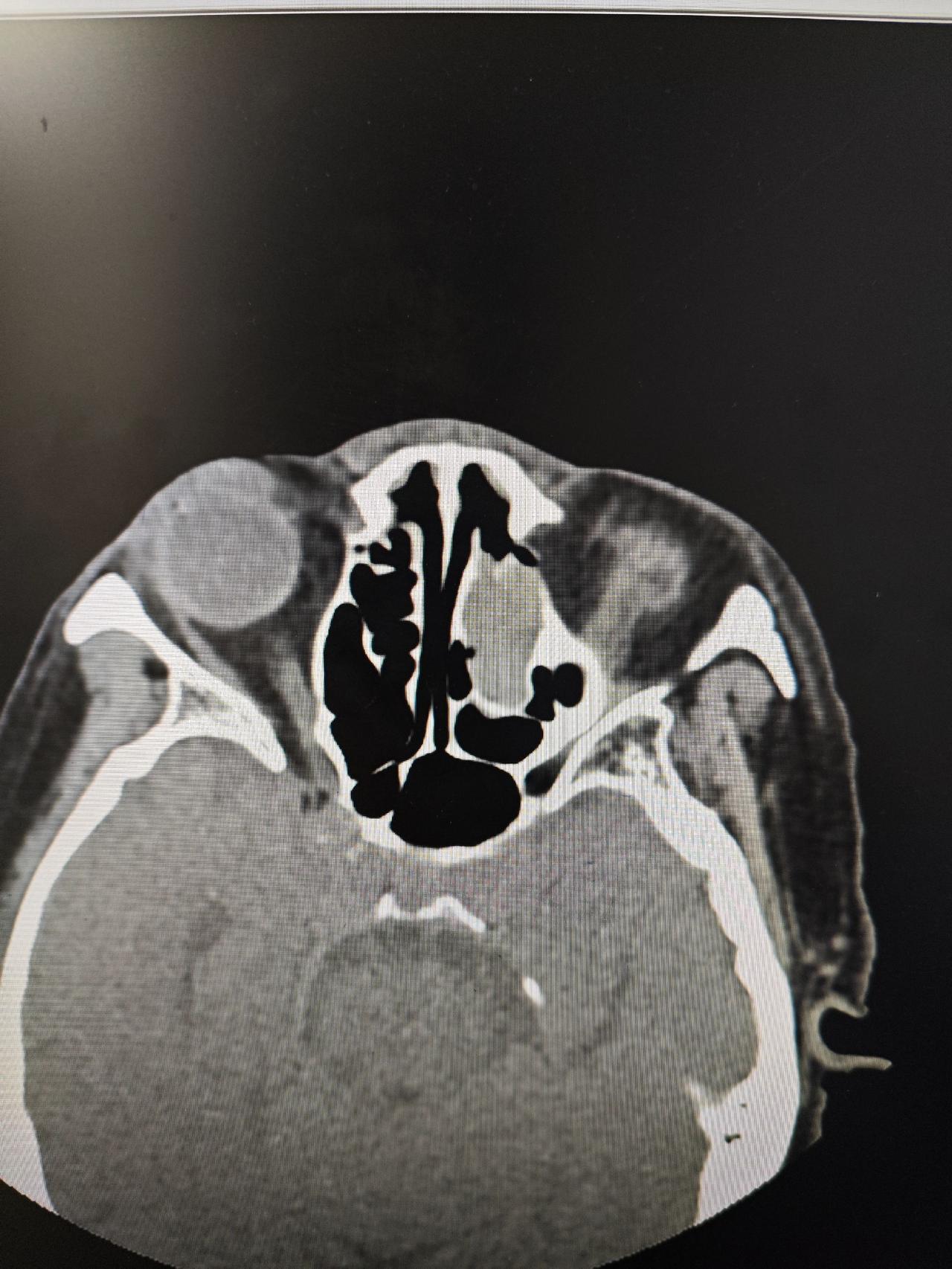 鼻腔鼻窦内翻性乳头状瘤术后三年复查，创面完全愈合，没有复发