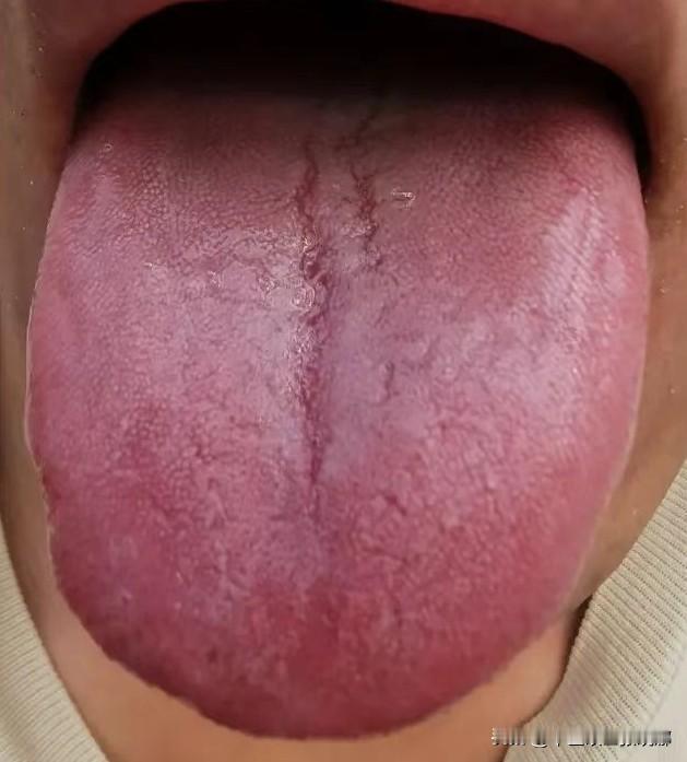 红舌不补阳，苔白不滋阴，补肾少走弯路

1、苔白不滋阴
原因：舌头显得较为肿胀，