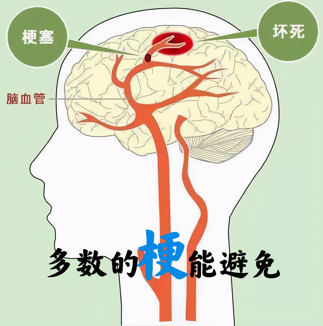 多数的梗，都有“懒”的影子

我不是医生，几十年也看到了很多心梗、脑梗事例，家人