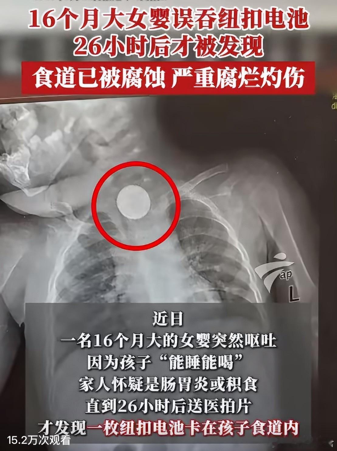 16个月女婴吞纽扣电池食道严重腐烂不到一岁半的小孩摸到什么吃什么，一定不要离开大