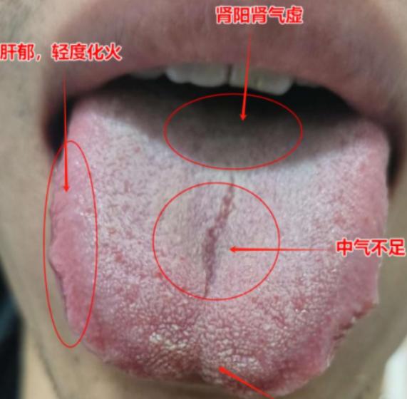 患者的这种舌象，先把脾胃调理好了，其他问题自然就消散了！
 
首先，咱们说说他为