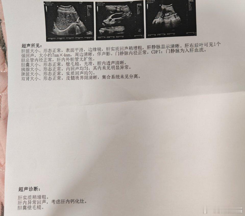#乙肝[超话]#好的，胆囊毛糙可能是乙肝引起的吗？后面抗病毒会不会改善胆囊毛糙肝