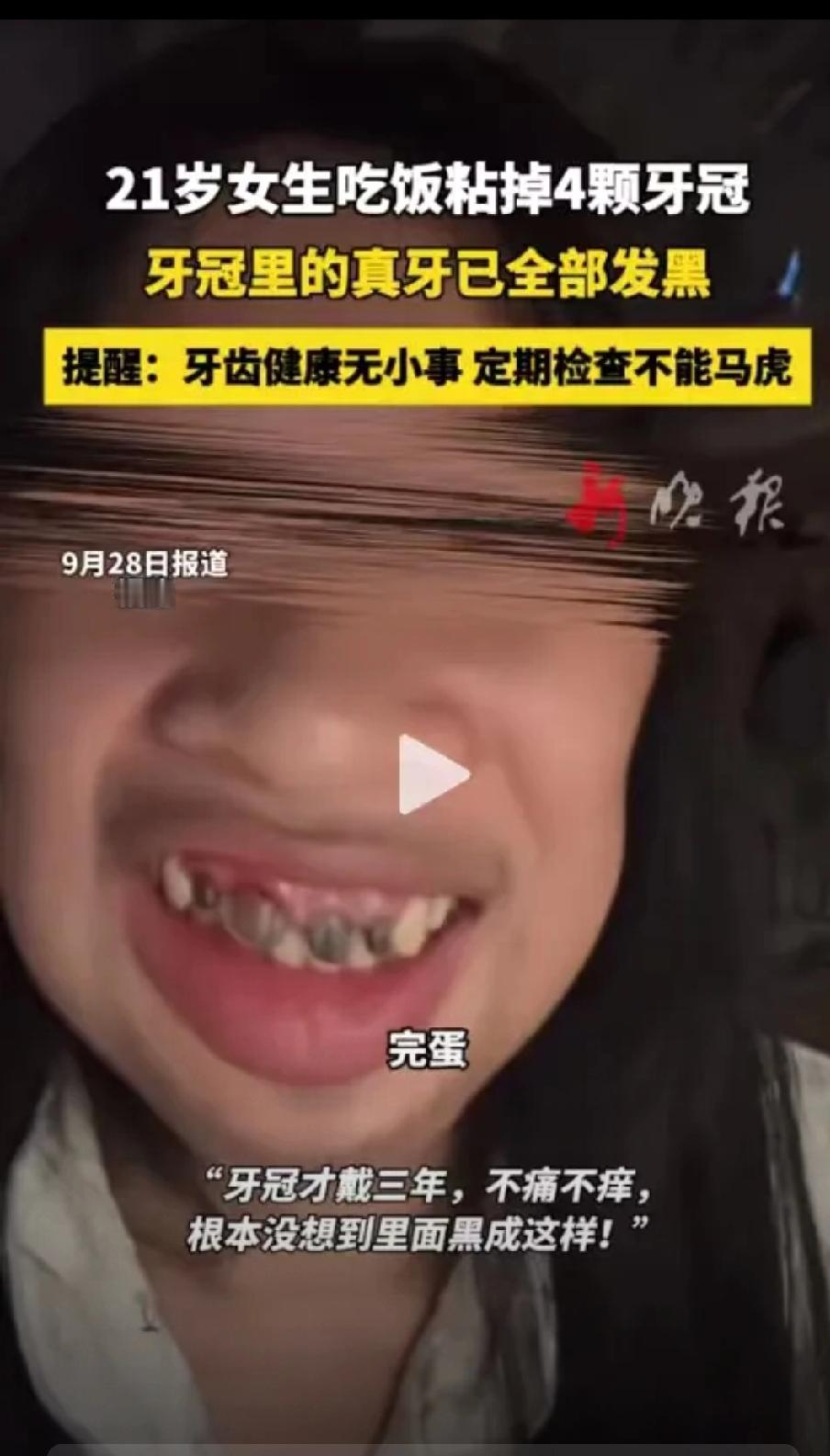 天塌了！

福建21岁女生吃饭时掉4个牙冠，真牙全部发黑。

女生：戴了3年没感