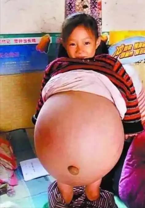 2010年，山西4岁女孩胡云星身患怪病，肚子鼓胀大如球，医生断言活不过三个月，就