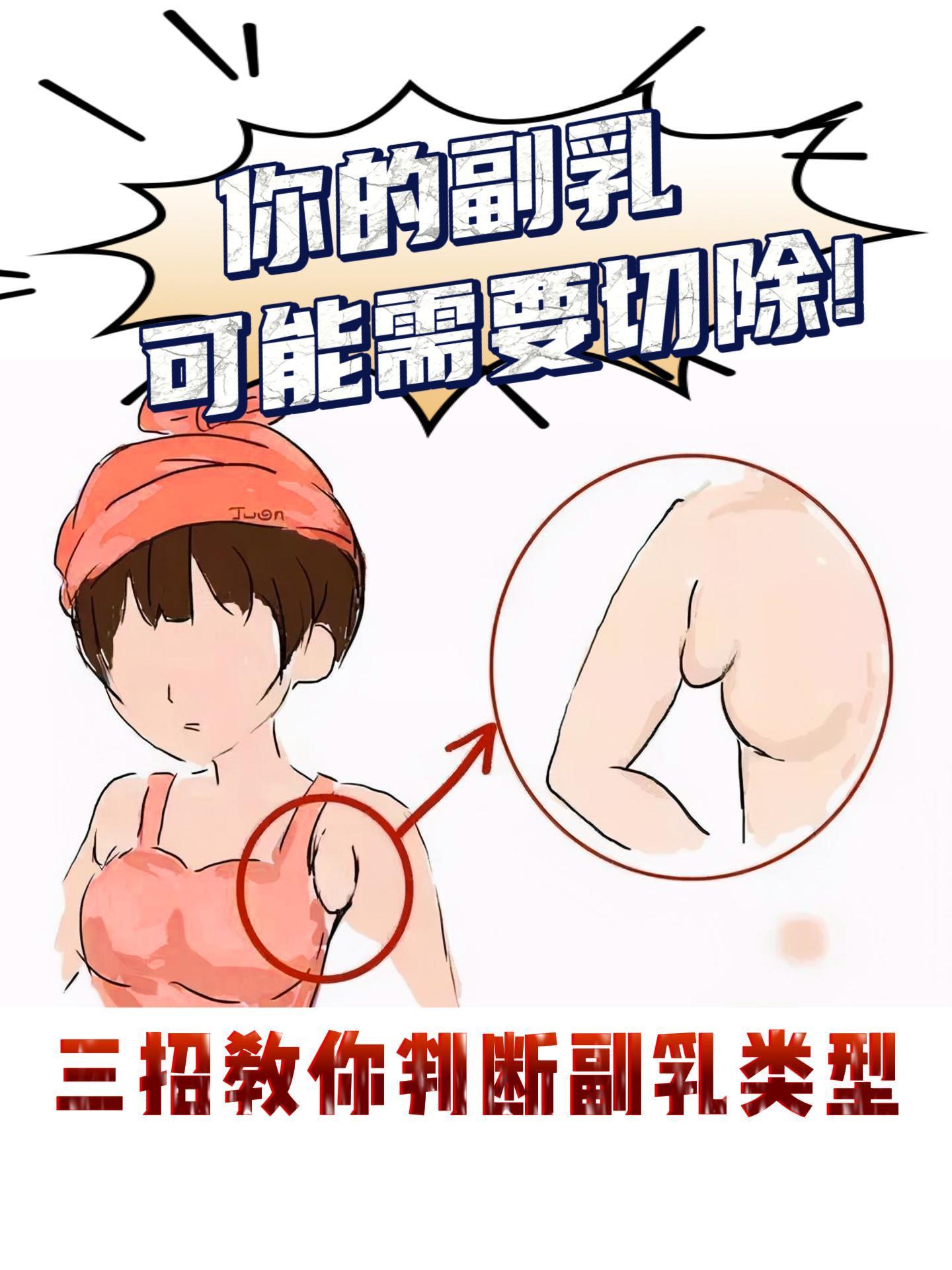 我们的副乳不一定能通过运动消除。真性副乳无法通过运动消除，如果副乳有乳...