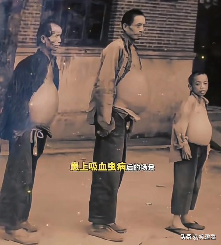 这是1956年，江苏镇江的一张罕见老照片，记录了祖孙三代患上“吸血虫”病后的场景