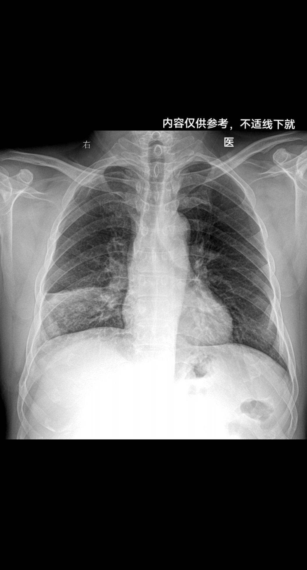 男 57y 咳嗽带红色痰 感冒胸闷就诊