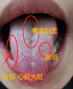 如果你是这一类的舌象，还在疏肝、健脾、补阳？那可真是大错特错了！
不管用再多的逍