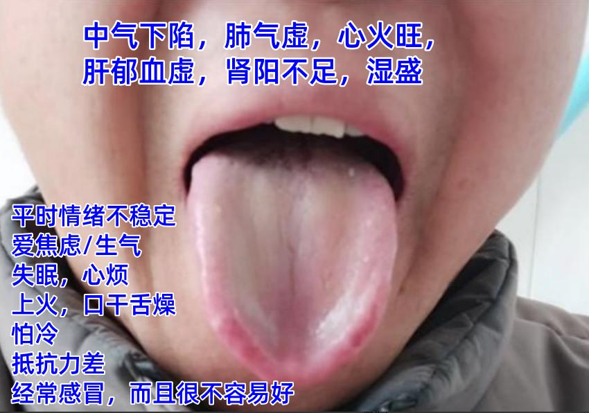 这会不忙，抽空帮大家继续分析舌象

如果有需要，尽管把你的舌头照片发过来，公益舌