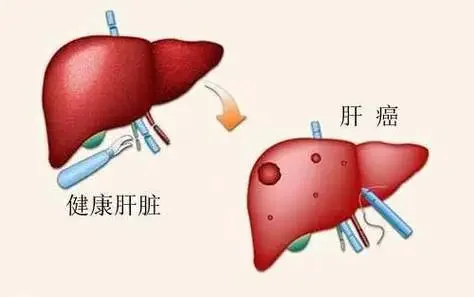 肝癌预防事项你知道吗？洪医生为大家总结了以下5条，希望能帮到大家~ 1...