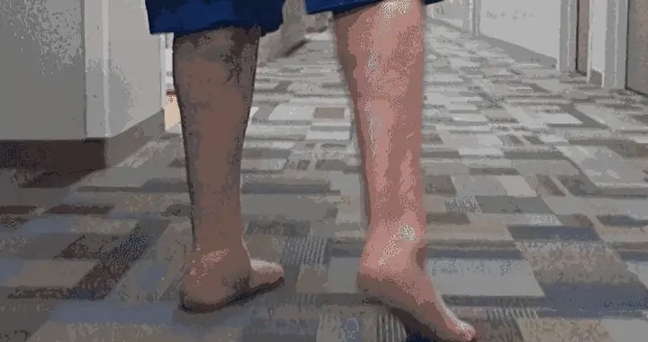 走路出现5种步态提示你血管可能堵了