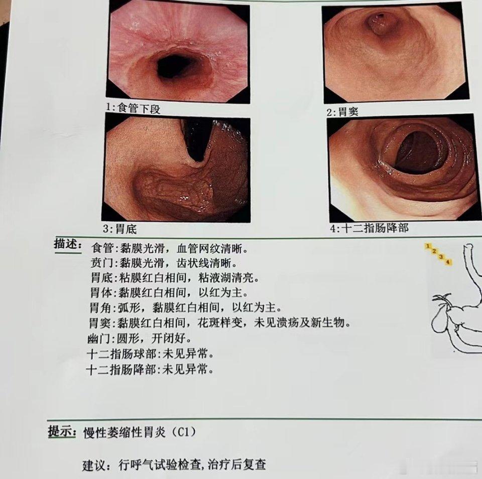 萎缩性胃炎是一种慢性胃炎，胃黏膜上皮和腺体萎缩，数目减少，胃黏膜变薄，黏膜基层增