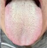 症状和舌象看着都是阳虚的表现，怎么一吃补药就上火呢？那是你忽略了这一点！

患者