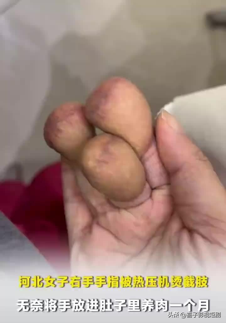 惊！女子手指截肢后放肚里“寄养”成小肉球

近日，一女子因意外手指严重受损需截肢