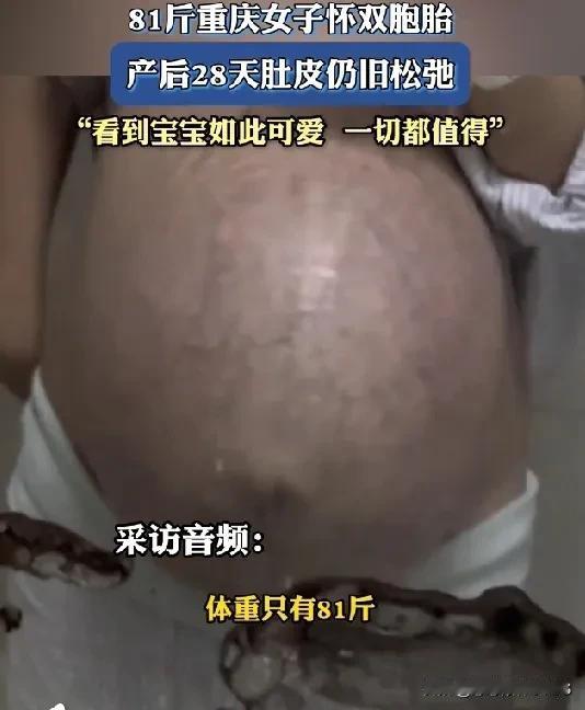 重庆有位妈妈，体重81斤，怀的是双胞胎。生完宝宝28天了，肚皮依旧松松垮垮的。尽