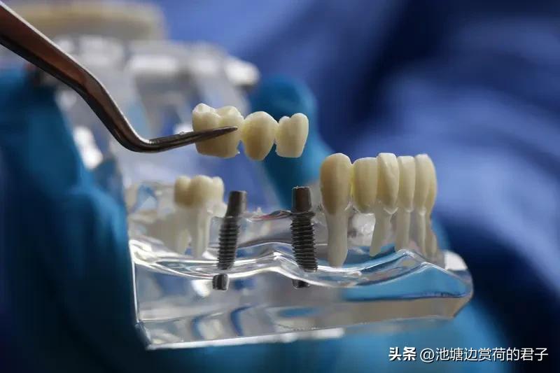 老人拔6颗牙做种植牙手术 4天后离世 西安70岁的孙先生在双宝口腔医院拔6颗牙做