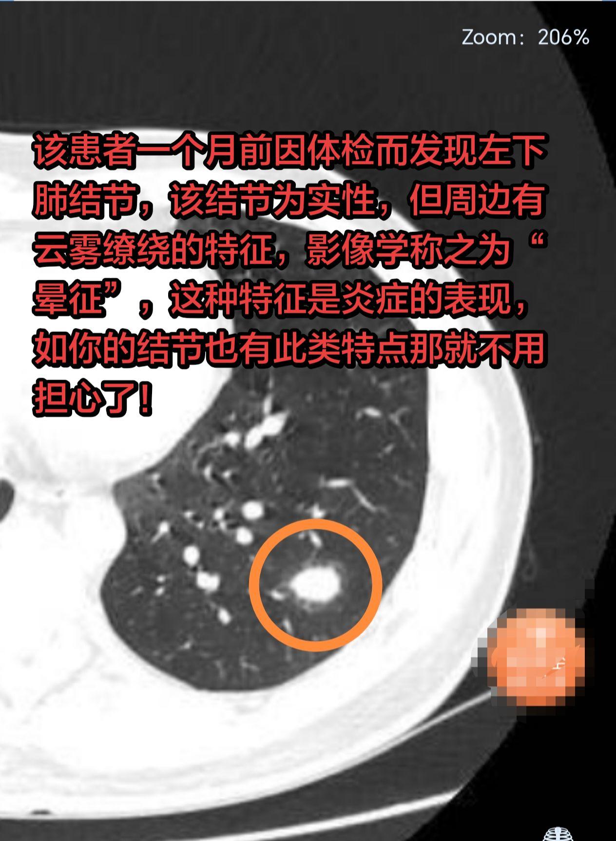 有“晕征”的结节多考虑炎症，看看你的有没。该患者一个月前因体检而发现左...