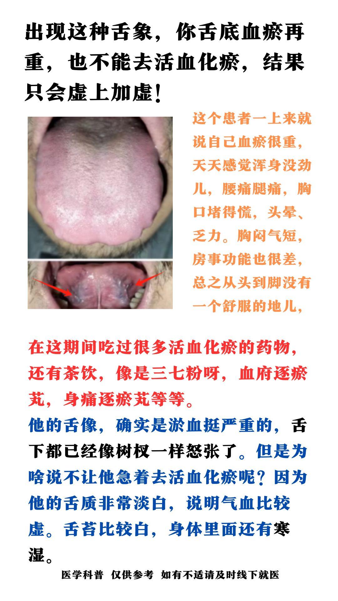 出现这种舌象，你舌底血瘀再重，也不能去活血化瘀，结果只会虚上加虚！#舌诊##健康