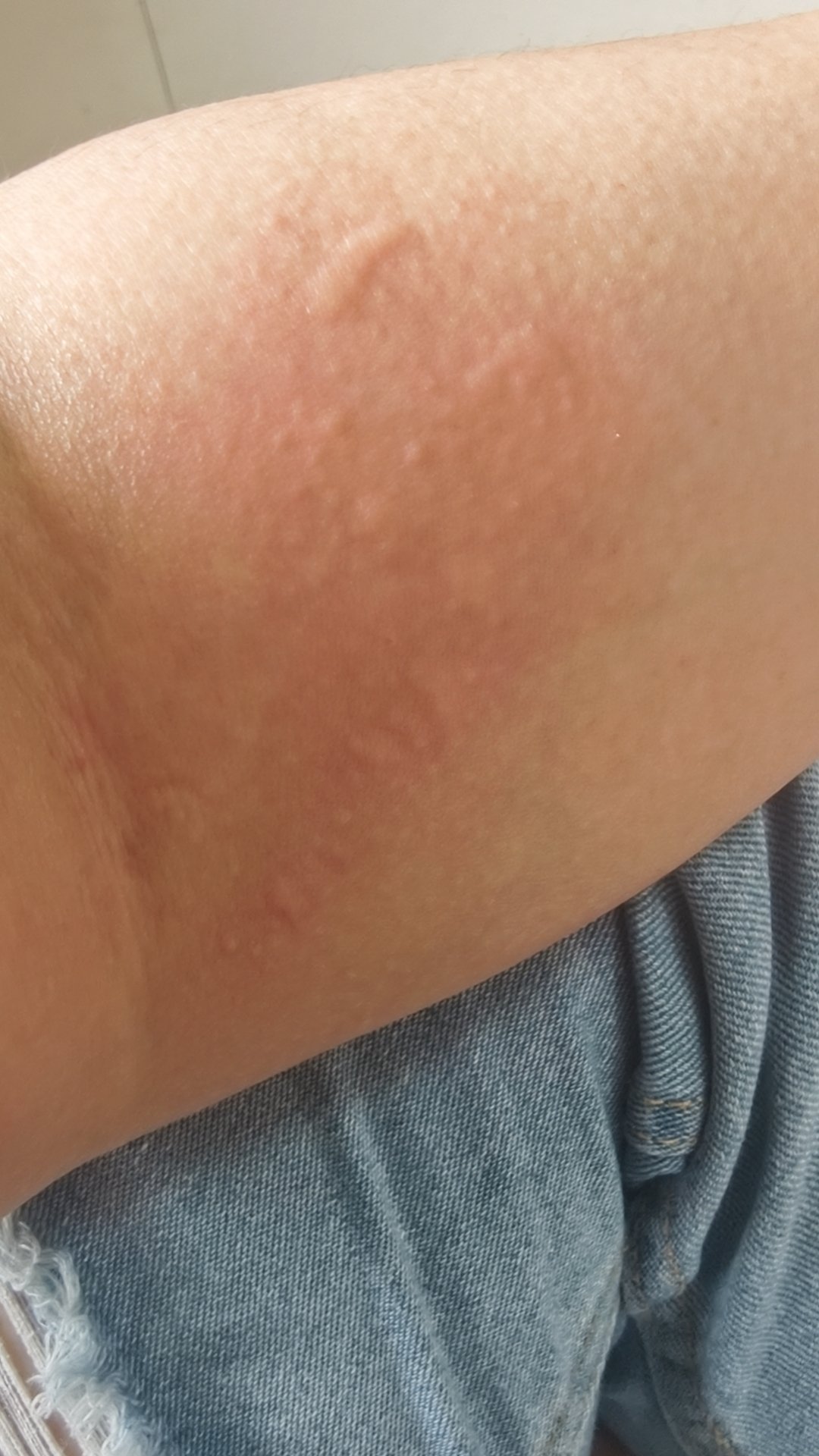 又开始了，真烦人，荨麻疹说来就来