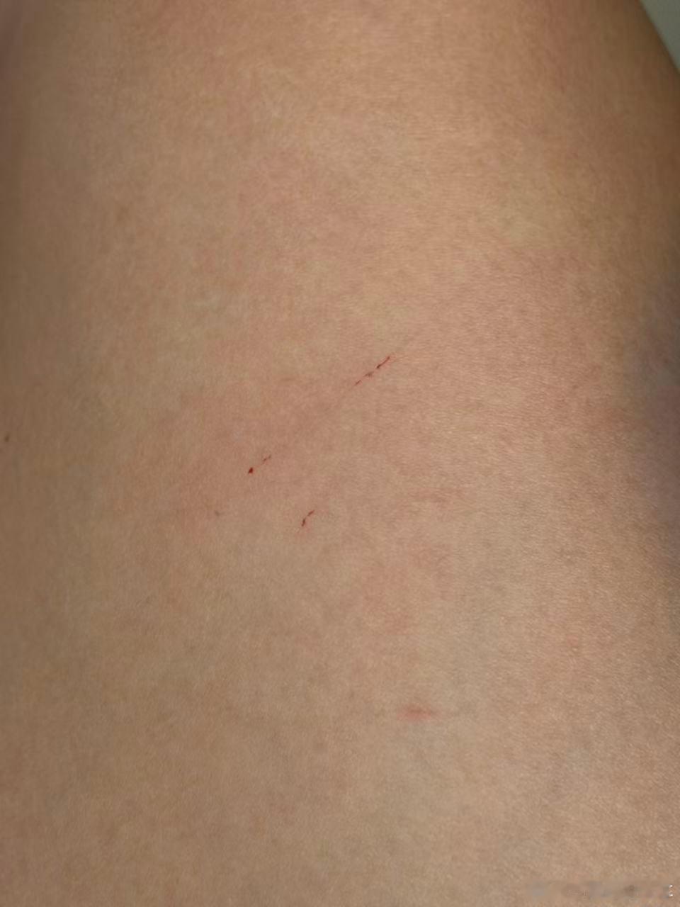 几个月小猫给媳妇给挠了！这种要不要去医院处理打疫苗？真心求助！ 天津