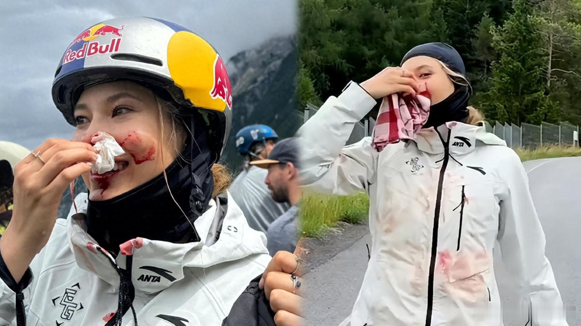 三连摔，谷爱凌惨遭千万级别的代言危机！三次致命反转，医疗报告显示前十字韧带三级撕