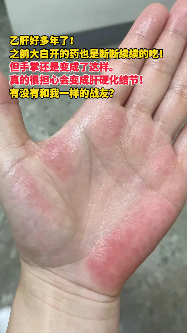 这是一名粉丝的吐槽，作为一名有着多年工作经验的中医肿瘤医生，特别理解患...