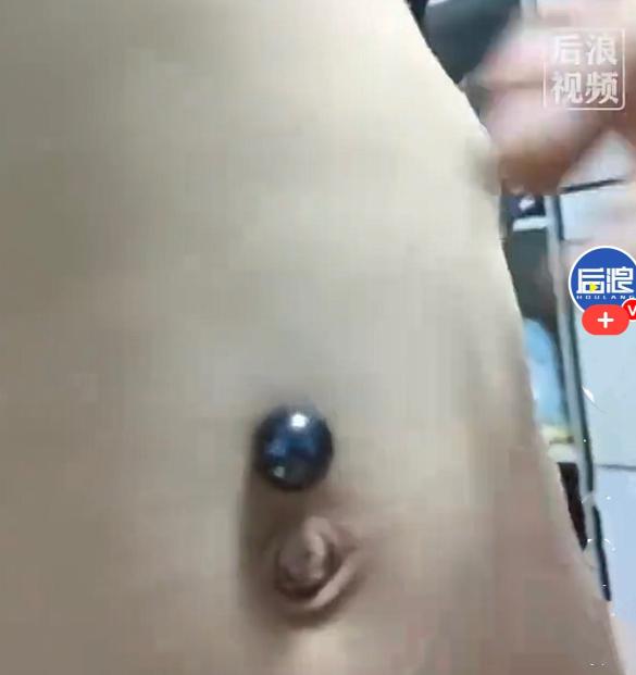 近日，云南昆明一名小男孩玩耍时，不慎将磁铁珠吞进肚子里。情急之下，孩子妈妈找来另