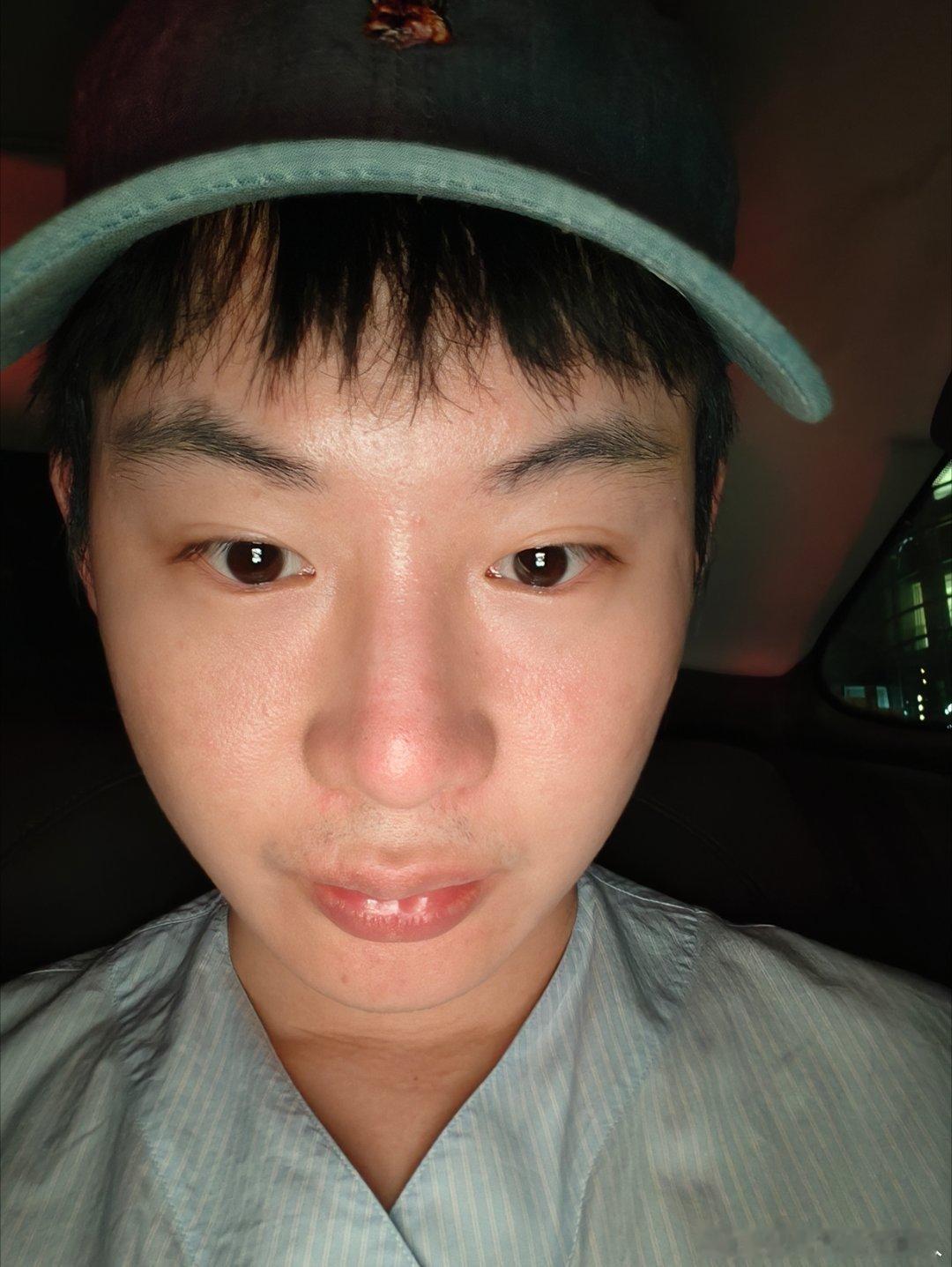 贴胶带 鼻子长了很多小红疹 