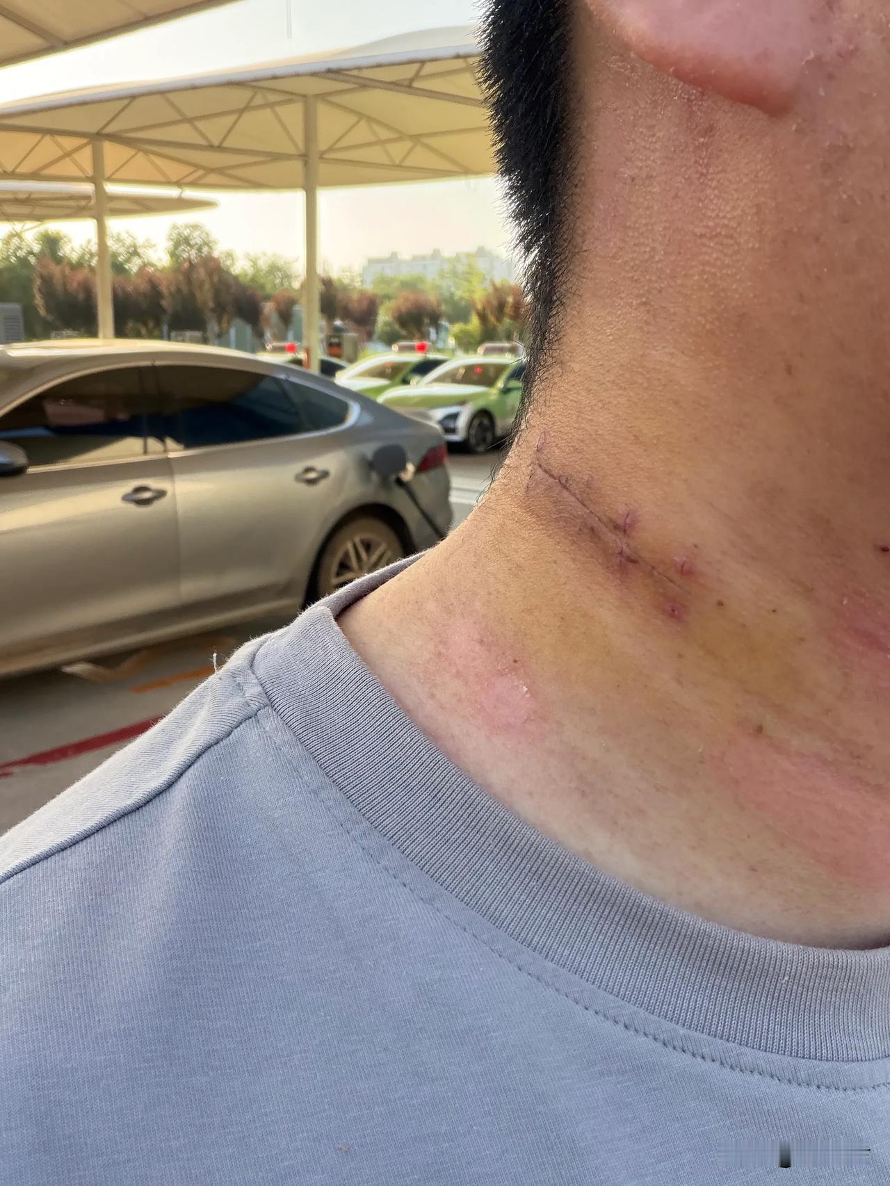 做手术颈部局部麻醉真的难受，就算拆线了，我还不习惯左右扭动脖子，接下来一个月不喝