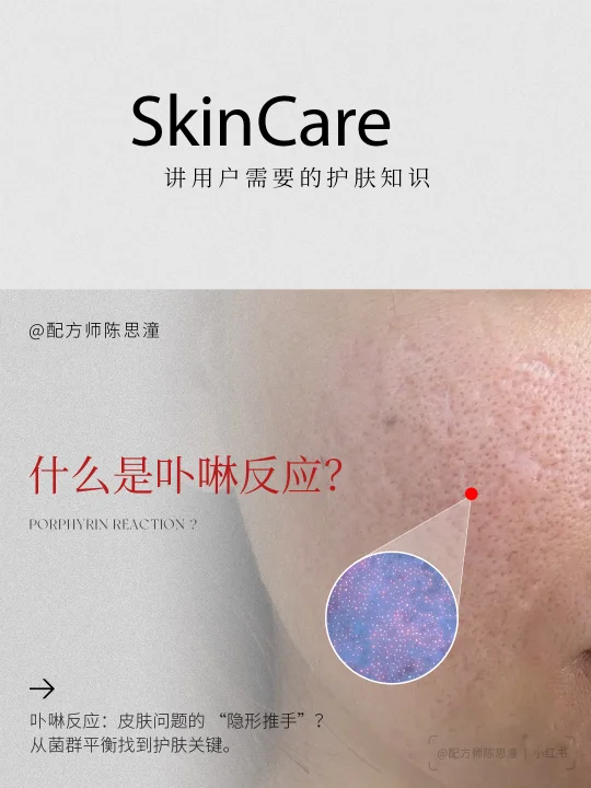 护肤知识｜从卟啉反应找到护肤关键