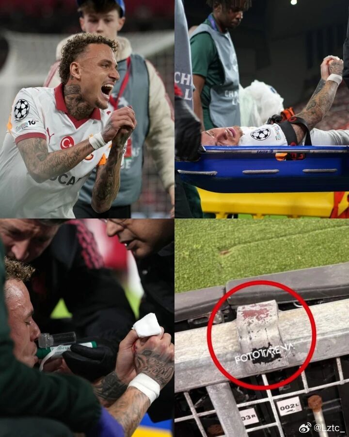 诺阿·朗：我的大拇指还连在手上，医生说能保住▼03月24日讯 欧冠1/8决赛次回