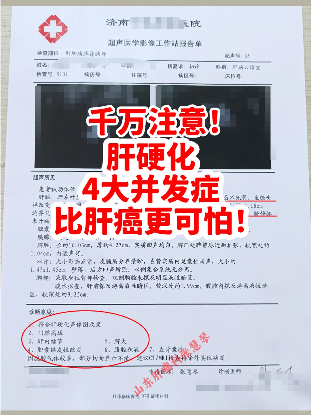 千万注意！肝硬化4大并发症一个比一个危险