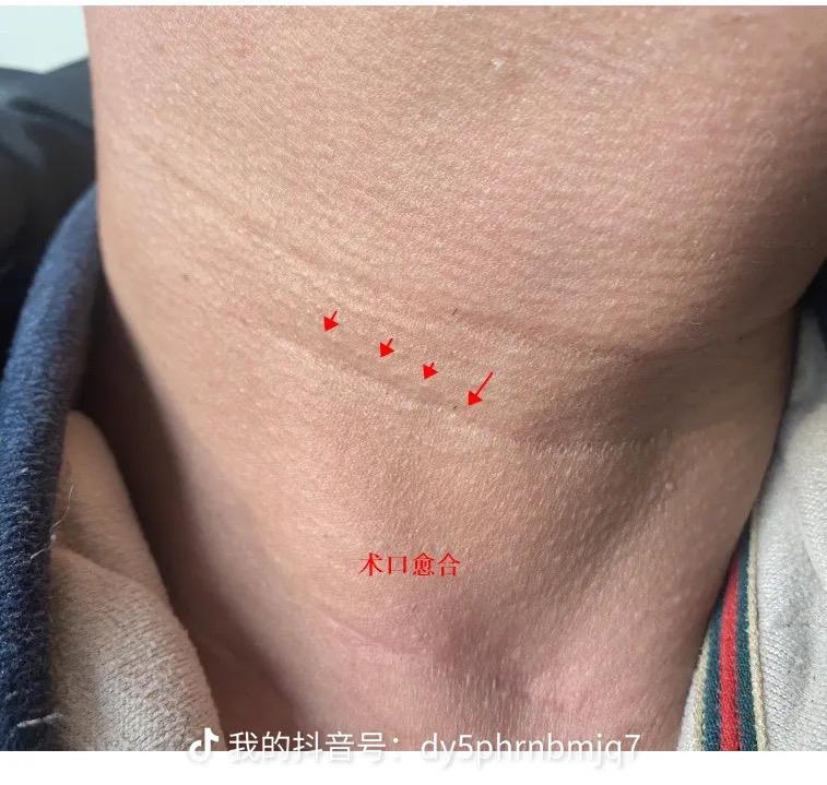 能看出颈椎手术过了吗。