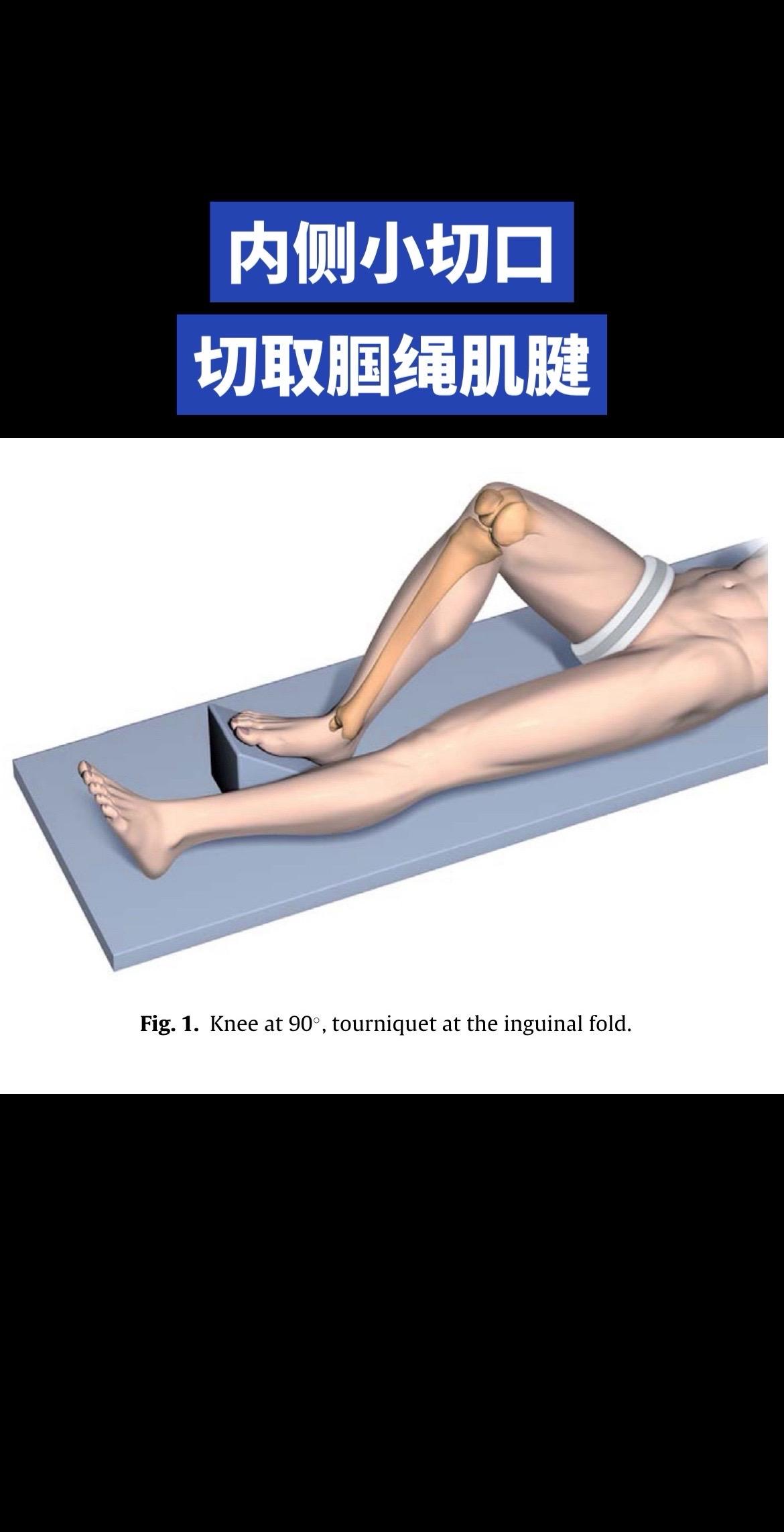 腘绳肌切取手术。全步骤解析｜医学解剖干货。移植物