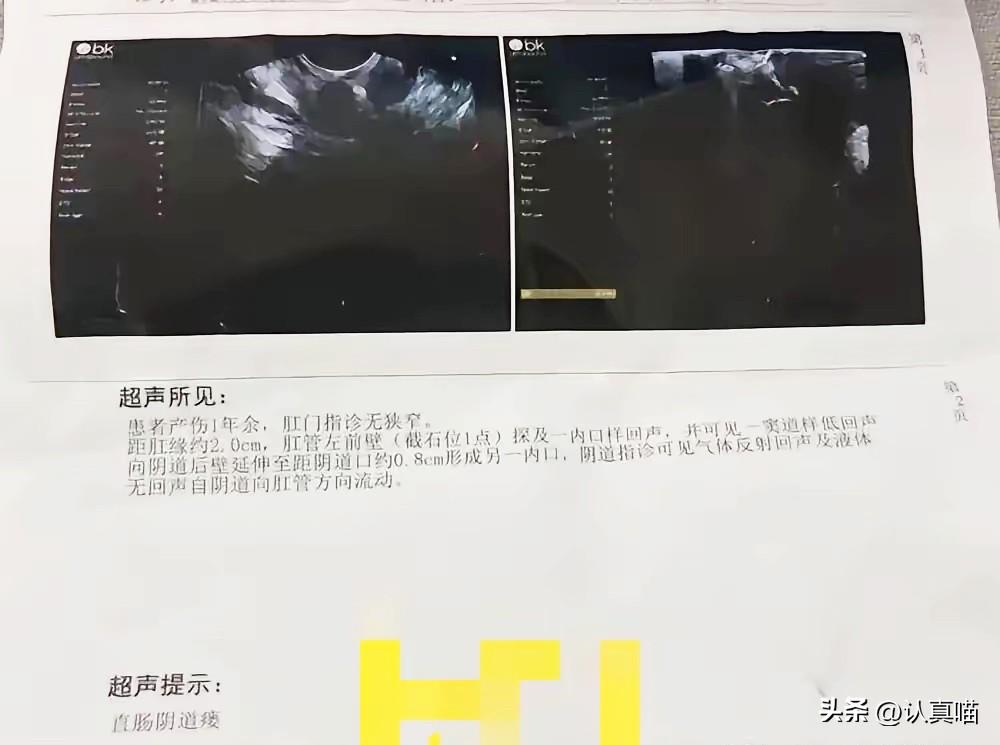 顺产缝错一针，毁掉母亲一生！隐瞒比失误更可怕

河北任丘这位妈妈，本是满怀期待迎