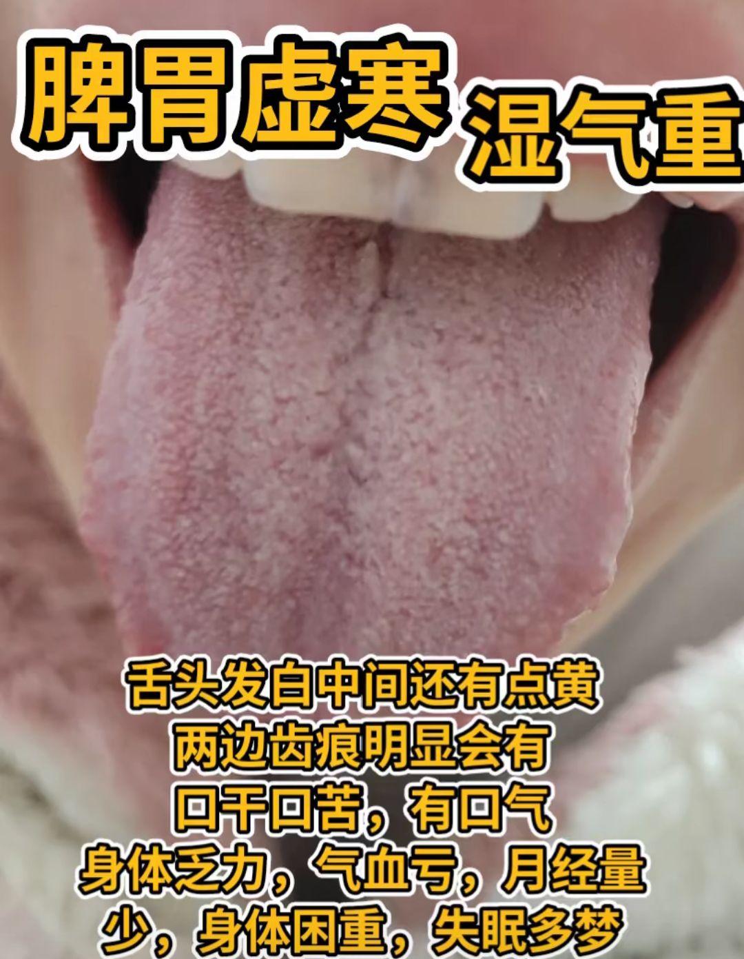 昨日看诊三位粉丝舌象 一起看看他们有什么相符的