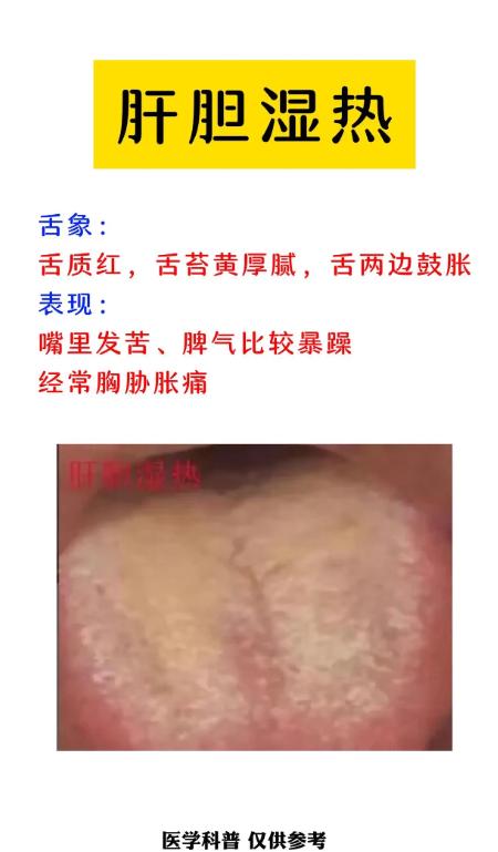同样是湿热，3 种不同类型，看舌头就懂