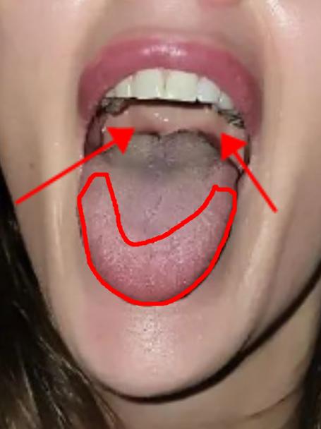 女同志一定要注意，这种舌象特别常见，不仅妇科问题严重，还要警惕最常见的乳腺增生，