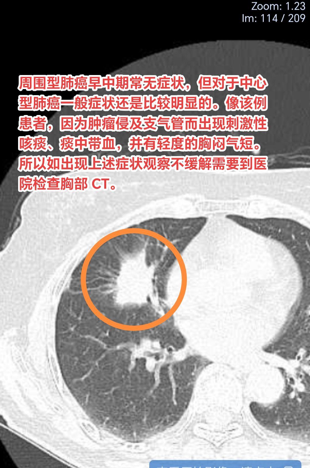 逐渐加重的刺激性干咳、痰中带血需警惕恶性。周围型肺癌早中期常无症状，但...